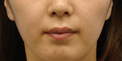 WPRPF nasolabial 30y after-thumb-500x250-1634.jpgのサムネール画像